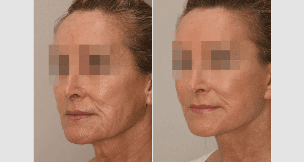 Vorher/Nachher Ergebnis: Facelift