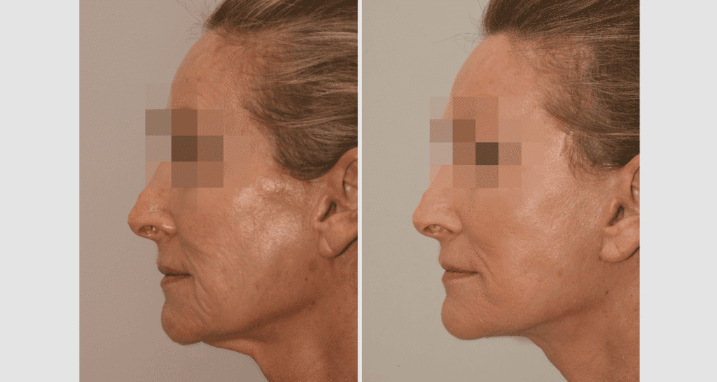 Woman's face before and after facelift procedure showing skin tightening.