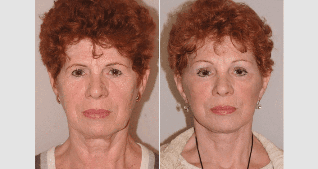 Vorher/Nachher Ergebnis: Facelift