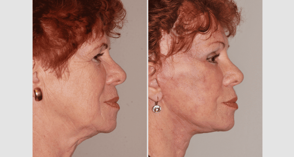 Vorher/Nachher Ergebnis: Facelift