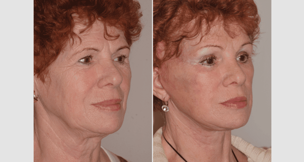 Vorher/Nachher Ergebnis: Facelift