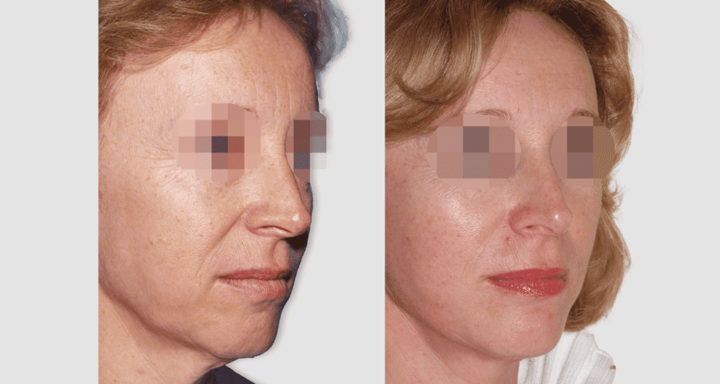 Vorher/Nachher Ergebnis: Facelift