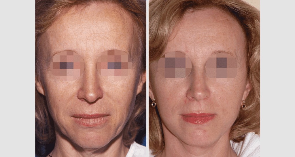 Vorher/Nachher Ergebnis: Facelift