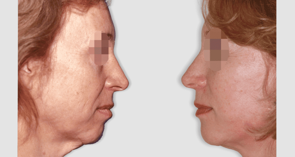 Vorher/Nachher Ergebnis: Facelift