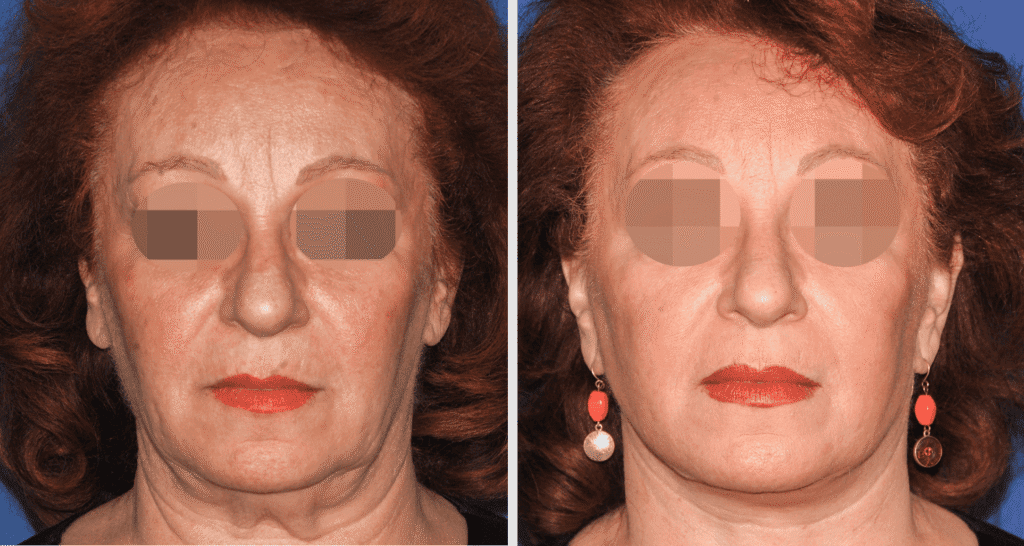 Vorher/Nachher Ergebnis: Facelift