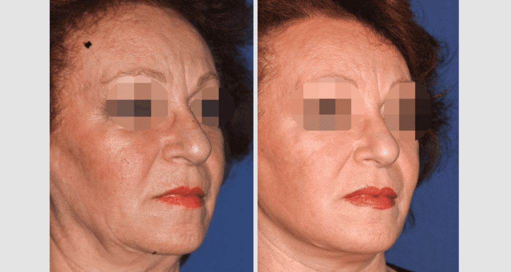 Vorher/Nachher Ergebnis: Facelift