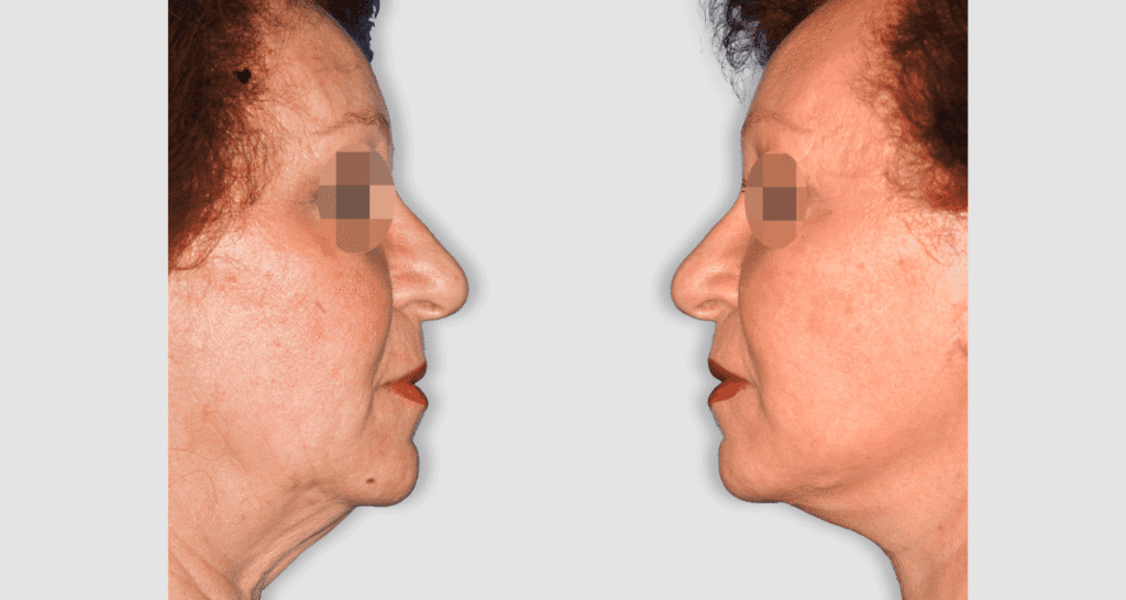 Vorher/Nachher Ergebnis: Facelift