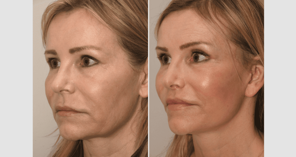 Vorher/Nachher Ergebnis: Facelift