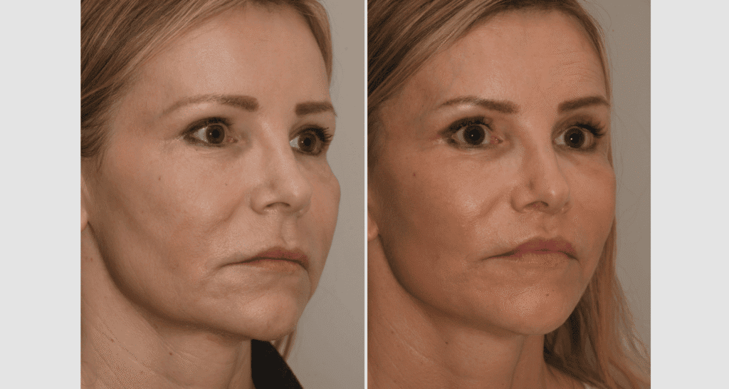 Vorher/Nachher Ergebnis: Facelift