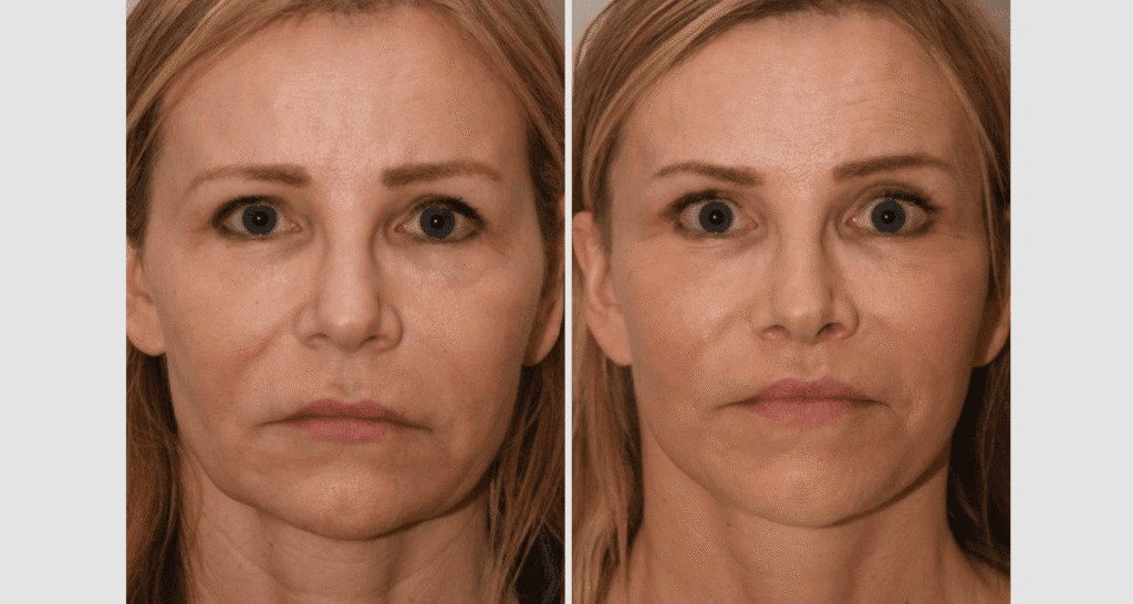 Vorher/Nachher Ergebnis: Facelift