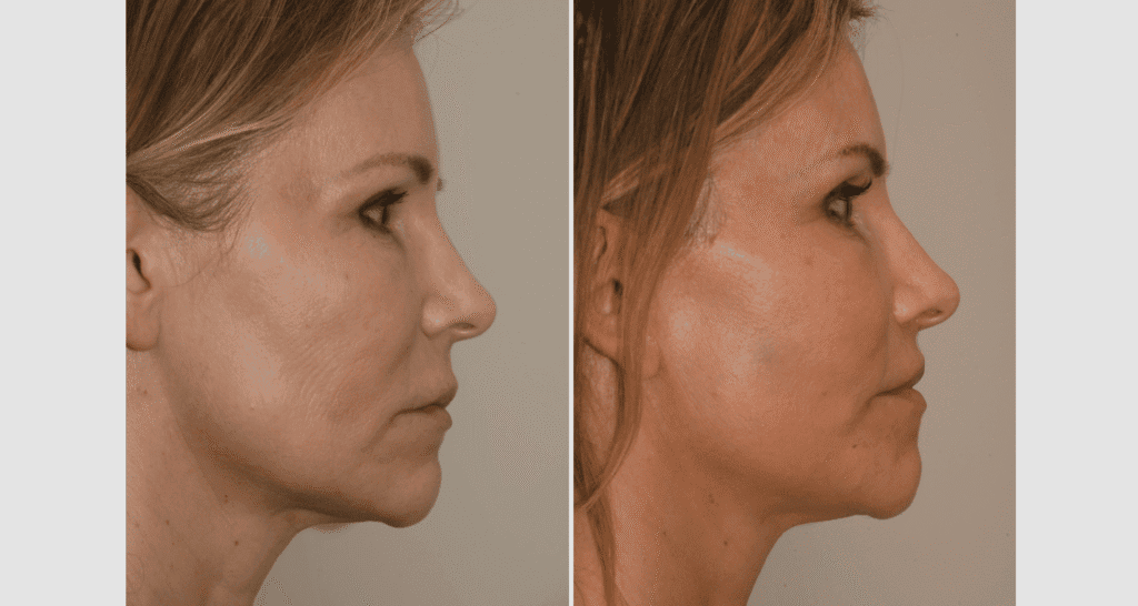 Vorher/Nachher Ergebnis: Facelift