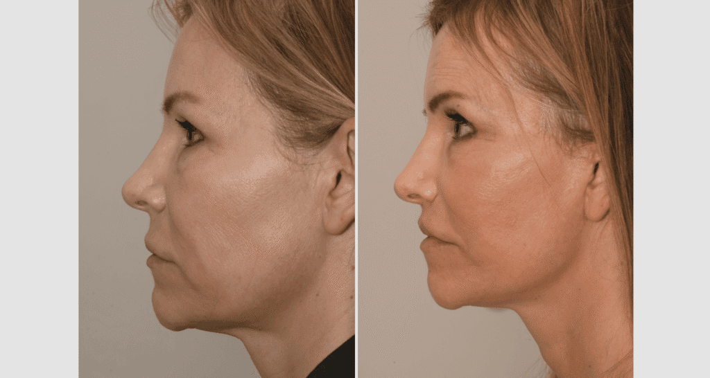 Vorher/Nachher Ergebnis: Facelift
