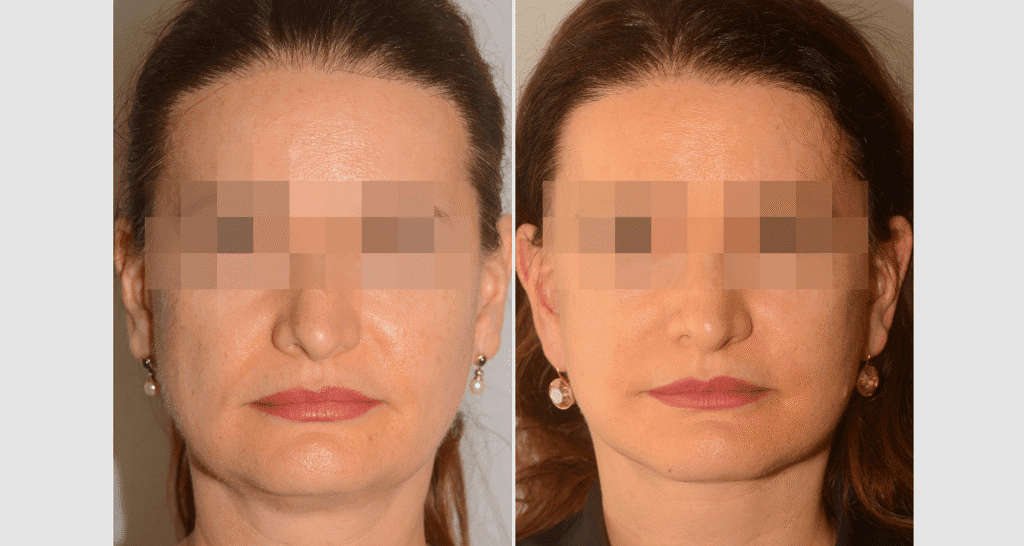 Vorher/Nachher Ergebnis: Facelift