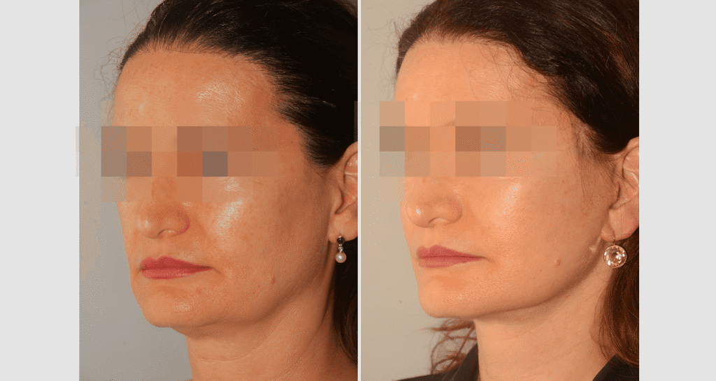 Vorher/Nachher Ergebnis: Facelift