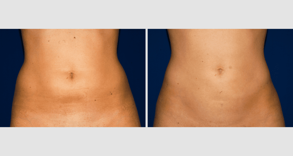 Vorher/Nachher Ergebnis: Fettabsaugung Bauch Huefte