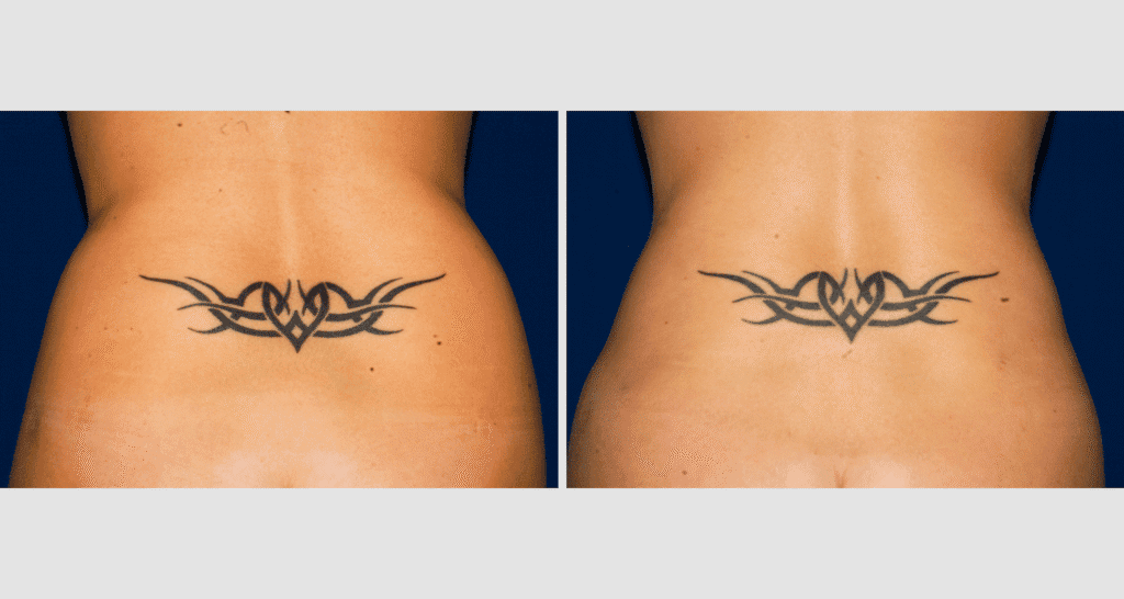Vorher/Nachher Ergebnis: Fettabsaugung Bauch Huefte