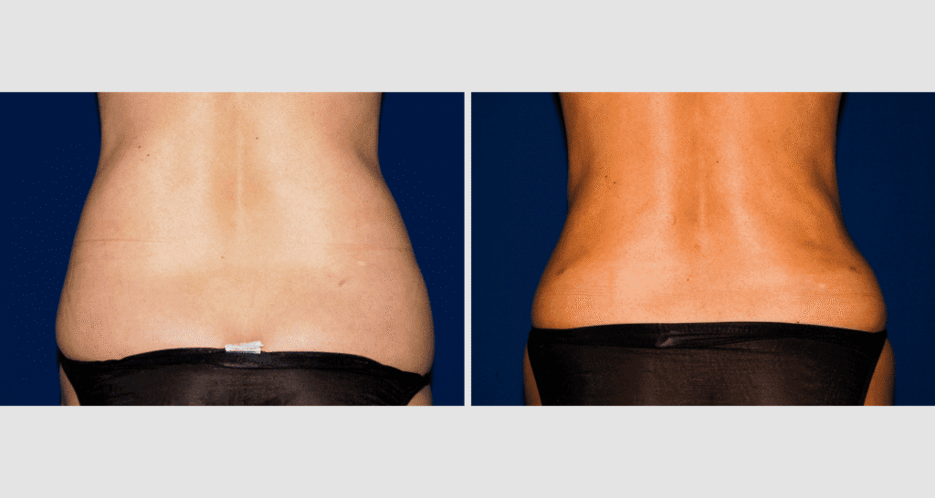 Vorher/Nachher Ergebnis: Fettabsaugung Bauch Huefte