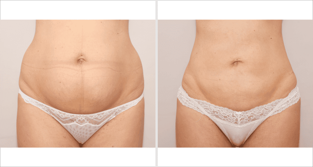 Vorher/Nachher Ergebnis: Fettabsaugung Bauch Huefte