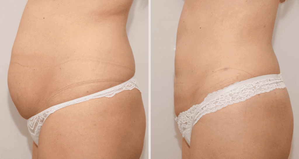 Vorher/Nachher Ergebnis: Fettabsaugung Bauch Huefte