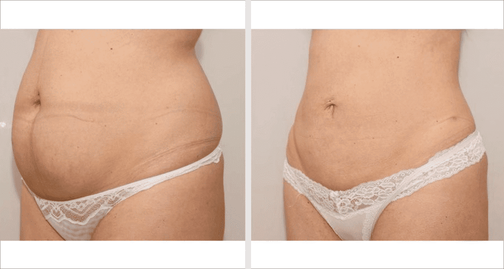 Vorher/Nachher Ergebnis: Fettabsaugung Bauch Huefte