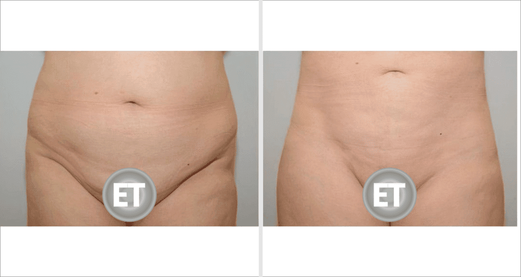 Vorher/Nachher Ergebnis: Fettabsaugung Bauch Huefte