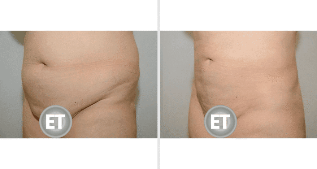 Abdomen liposuction results showing reduction of fat and improved contour.