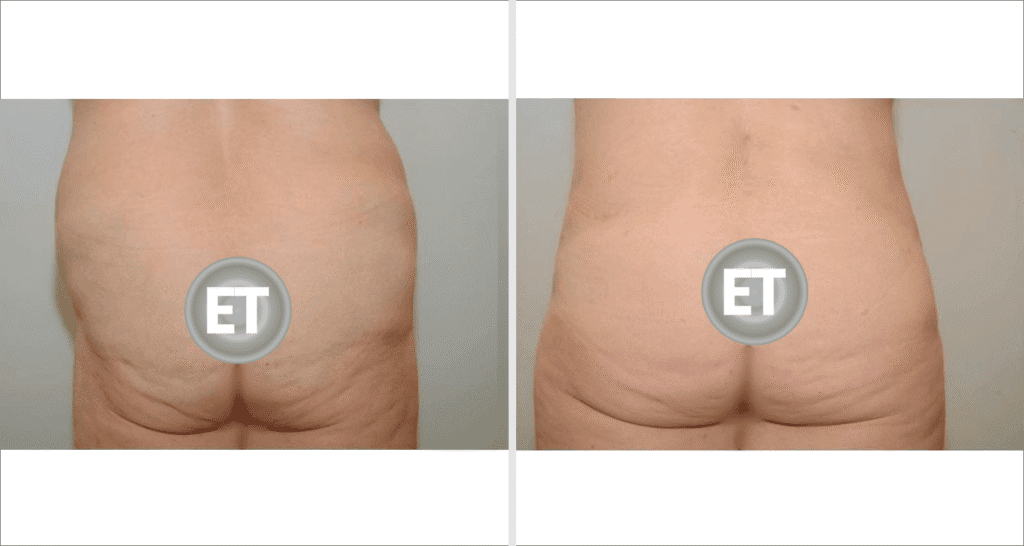 Vorher/Nachher Ergebnis: Fettabsaugung Bauch Huefte