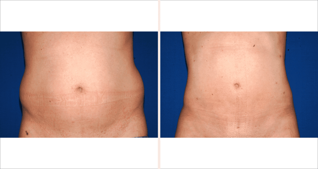 Vorher/Nachher Ergebnis: Fettabsaugung Bauch Huefte