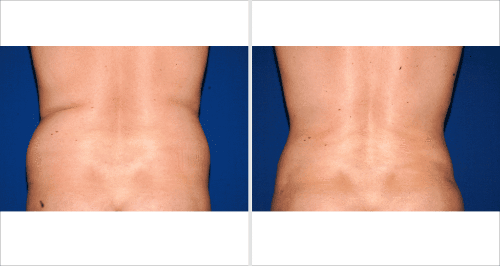 Vorher/Nachher Ergebnis: Fettabsaugung Bauch Huefte