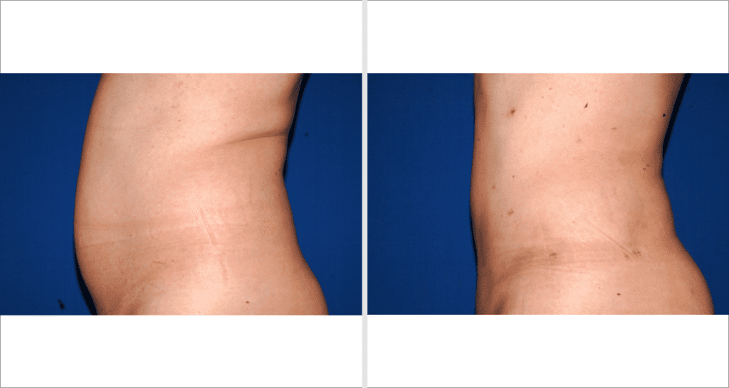 Vorher/Nachher Ergebnis: Fettabsaugung Bauch Huefte