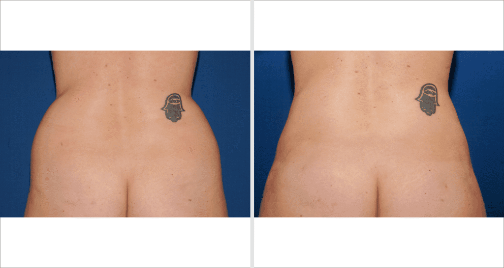 Vorher/Nachher Ergebnis: Fettabsaugung Bauch Huefte