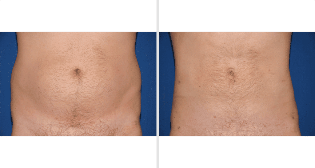 Vorher/Nachher Ergebnis: Fettabsaugung Bauch Huefte