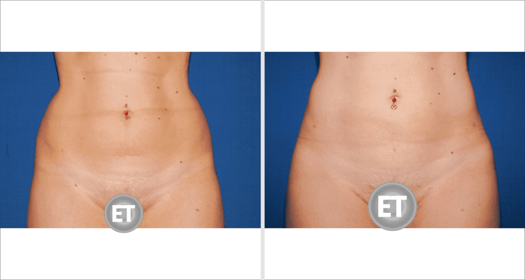 Vorher/Nachher Ergebnis: Fettabsaugung Bauch Huefte