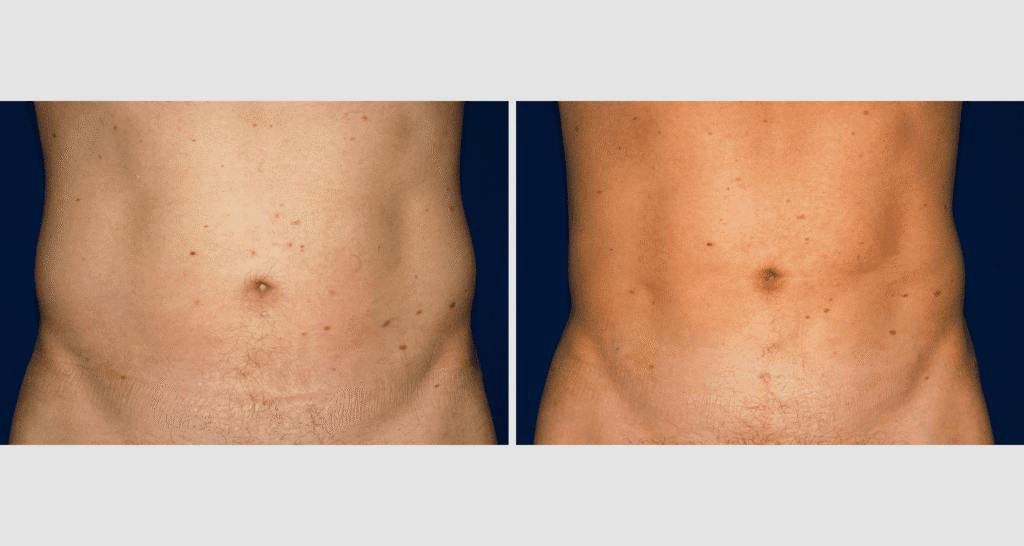 Vorher/Nachher Ergebnis: Fettabsaugung Bauch Huefte