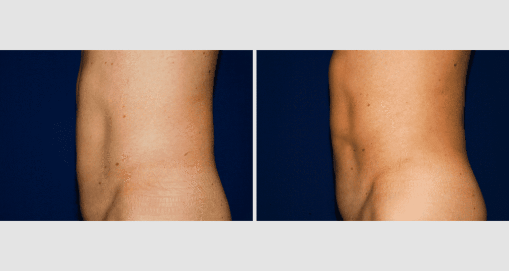 Vorher/Nachher Ergebnis: Fettabsaugung Bauch Huefte