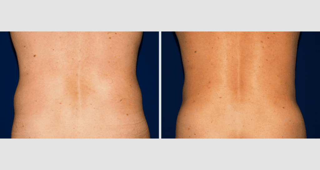 Vorher/Nachher Ergebnis: Fettabsaugung Bauch Huefte