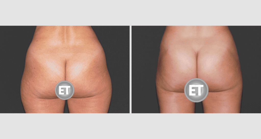 Vorher/Nachher Ergebnis: Fettabsaugung Bauch Huefte