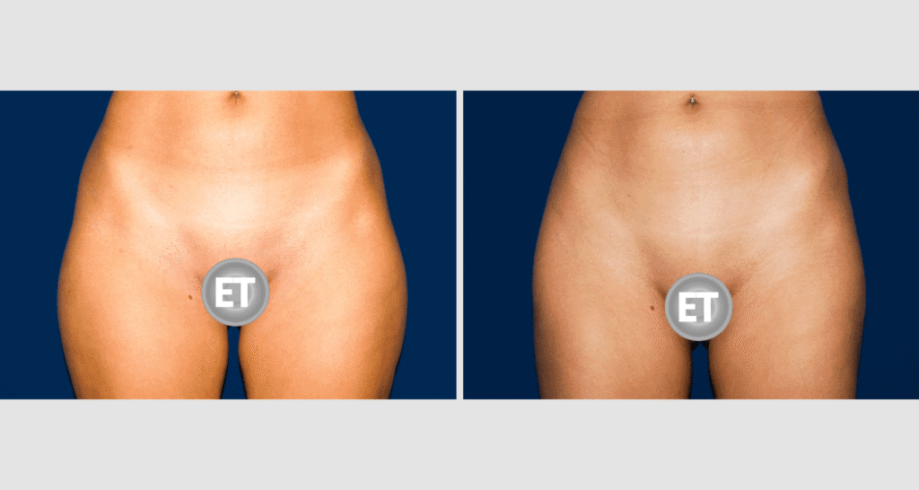 Vorher/Nachher Ergebnis: Fettabsaugung Bauch Huefte