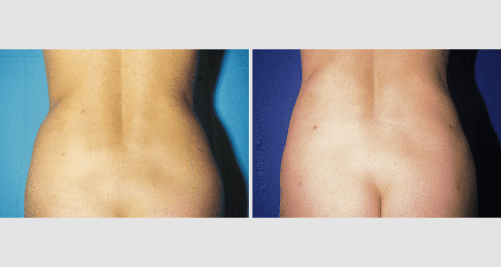 Vorher/Nachher Ergebnis: Fettabsaugung Bauch Huefte