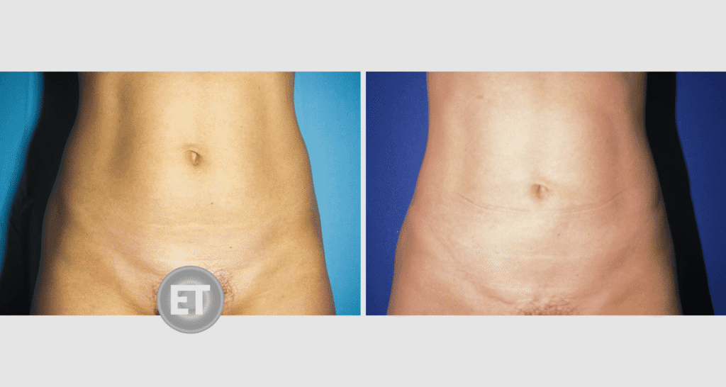 Vorher/Nachher Ergebnis: Fettabsaugung Bauch Huefte