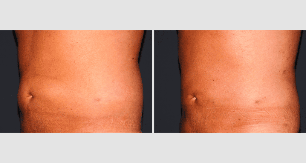 Vorher/Nachher Ergebnis: Fettabsaugung Bauch Huefte