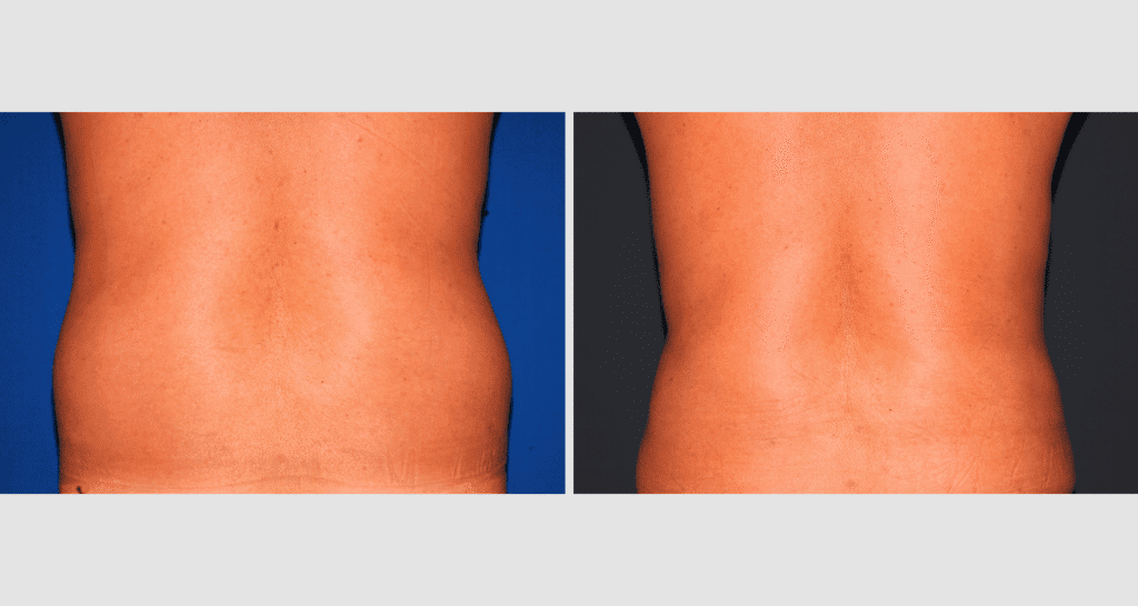 Vorher/Nachher Ergebnis: Fettabsaugung Bauch Huefte