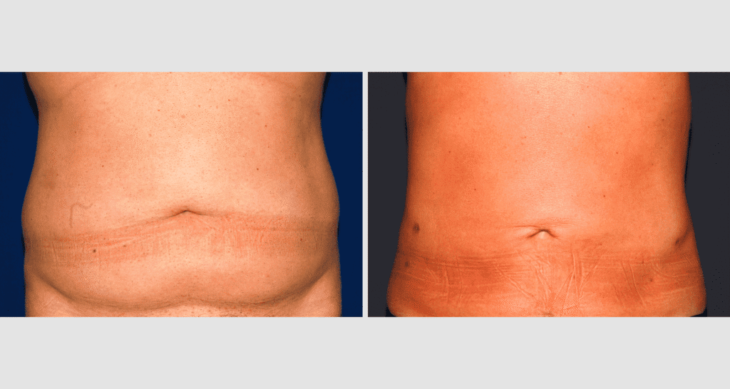 Vorher/Nachher Ergebnis: Fettabsaugung Bauch Huefte