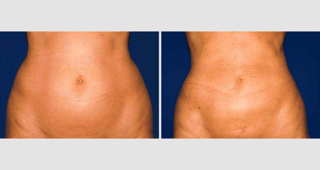 Vorher/Nachher Ergebnis: Fettabsaugung Bauch Huefte