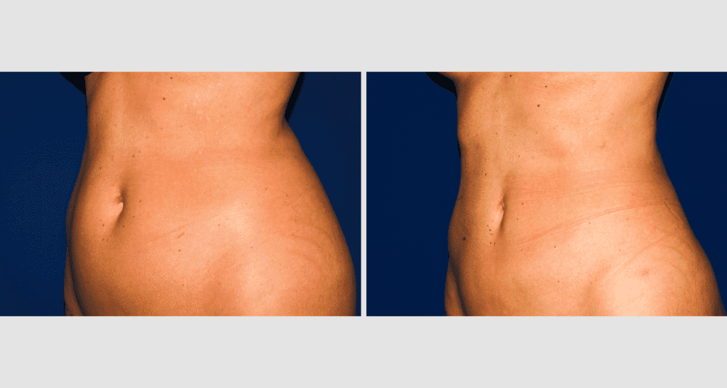 Vorher/Nachher Ergebnis: Fettabsaugung Bauch Huefte