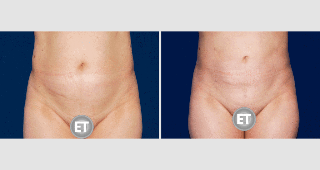 Vorher/Nachher Ergebnis: Fettabsaugung Bauch Huefte