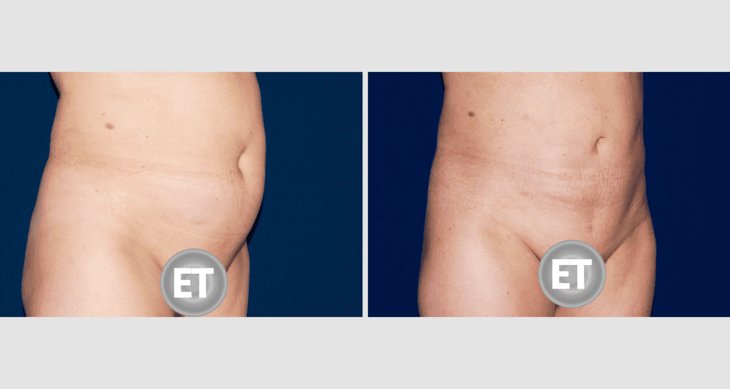 Vorher/Nachher Ergebnis: Fettabsaugung Bauch Huefte