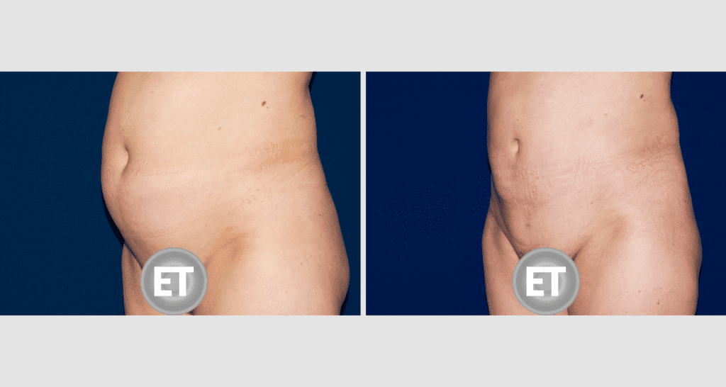 Vorher/Nachher Ergebnis: Fettabsaugung Bauch Huefte