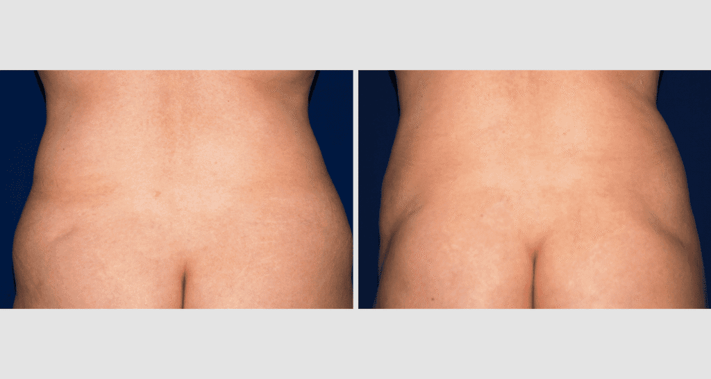 Vorher/Nachher Ergebnis: Fettabsaugung Bauch Huefte