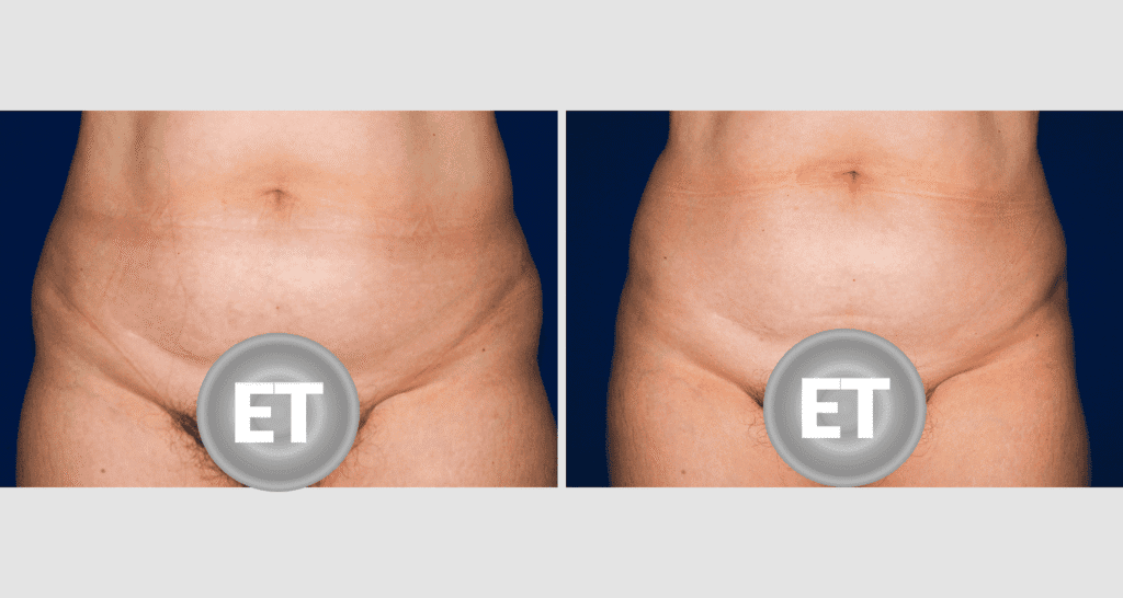 Vorher/Nachher Ergebnis: Fettabsaugung Bauch Huefte